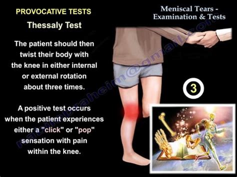 special tests for assessing meniscal tears within the knee|special tests for meniscus tear.